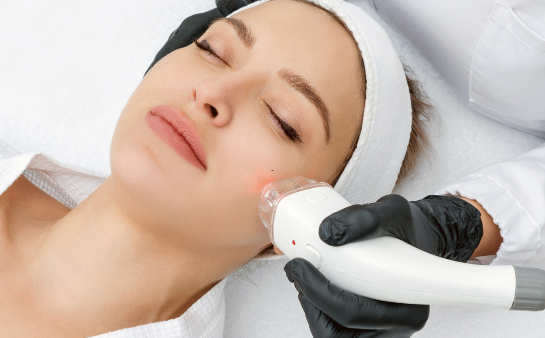 Fractional CO2 Laser Resurfacing Price Guide in Chevy Chase, Maryland